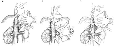 Renal Cell Carcinoma With Inferior Vena Cava Tumor Thrombus in Two Patients With Previous Coronary Artery Bypass Graft: Strategy for Surgical Removal